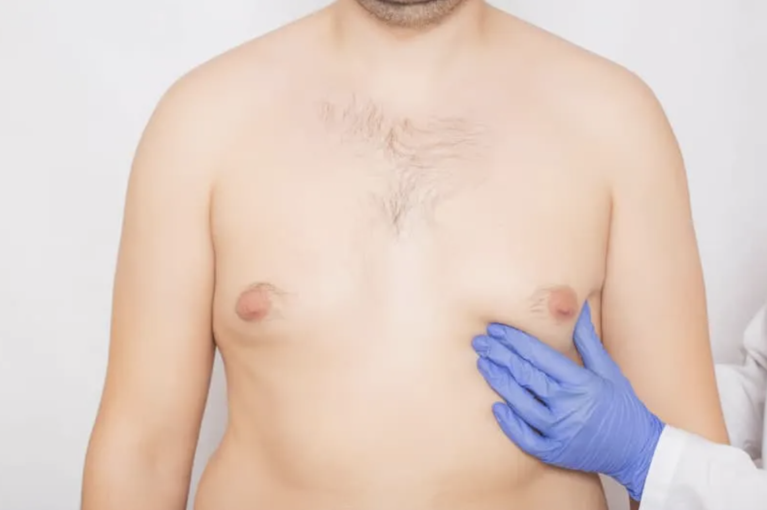 Does Insurance Cover Gynecomastia? Portland