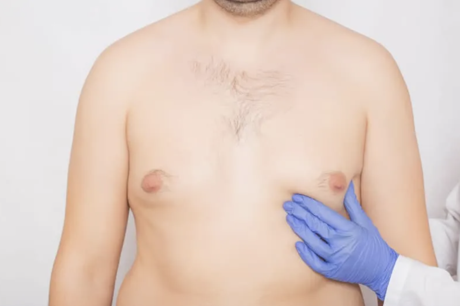 Puffy Nipples in Men, How to Get Rid of Man Boobs, Gynecomastia, Chest Fat