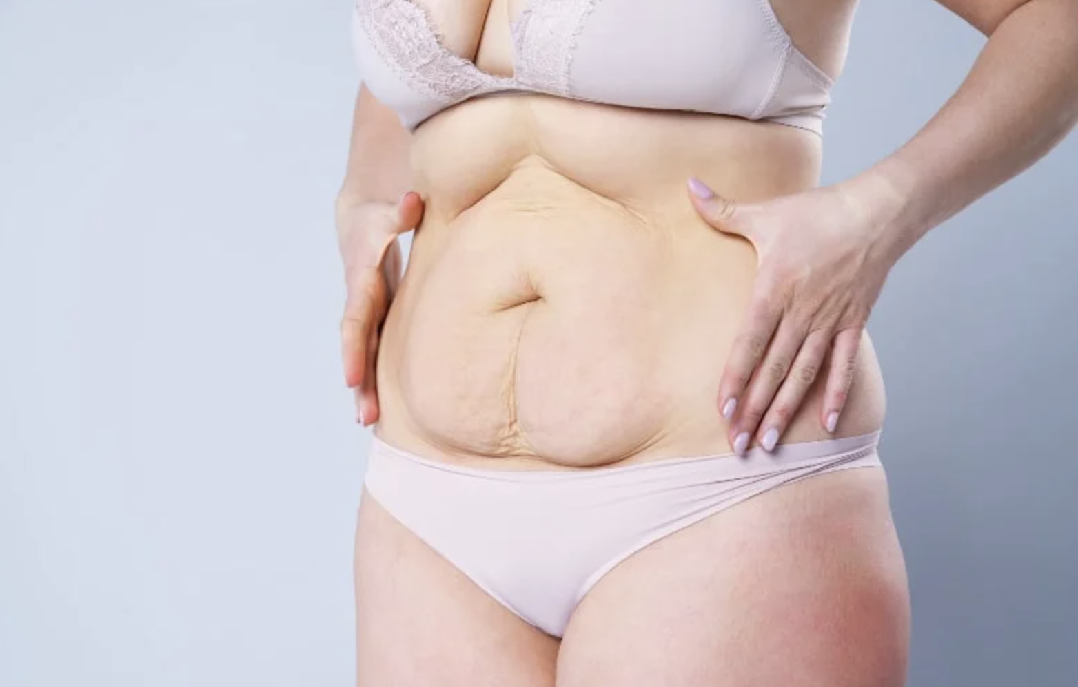 What Is a Plus Size Tummy Tuck?