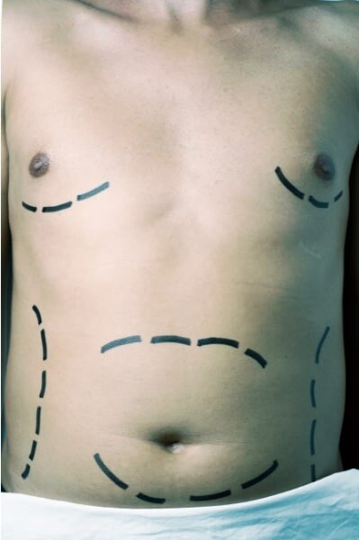 Is gynecomastia surgery covered by insurance