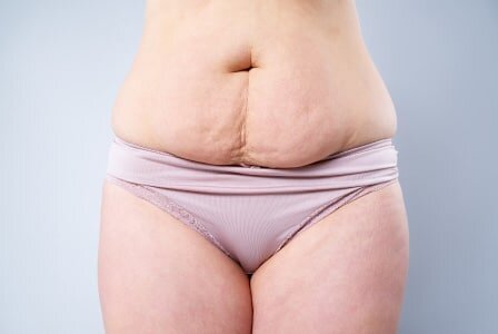 What Kind of Scars Will I Have After My Tummy Tuck?