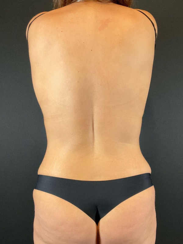 Brazilian Butt Lift Before & After Image