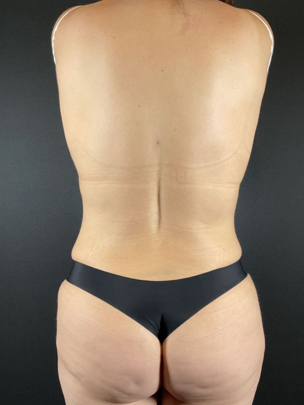 Brazilian Butt Lift Before & After Image