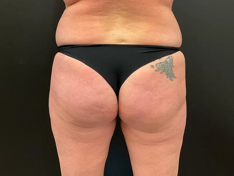 Brazilian Butt Lift Before & After Image