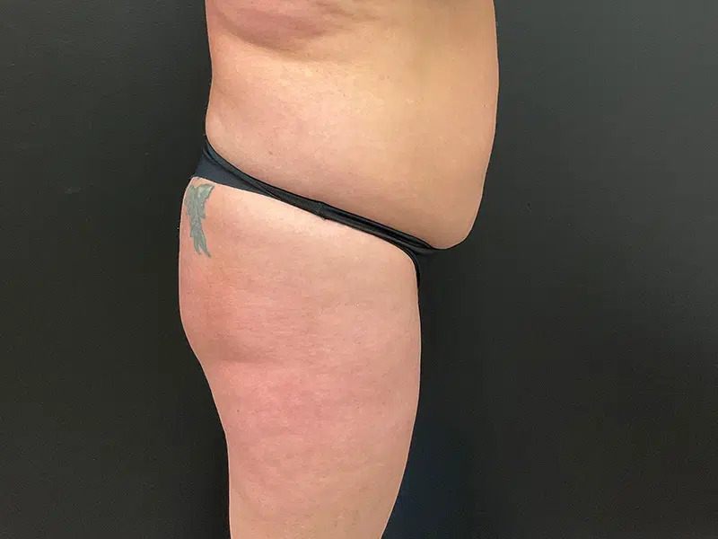 Brazilian Butt Lift Before & After Image