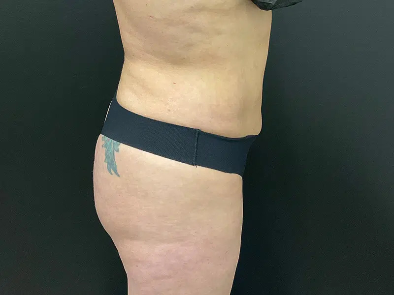 Brazilian Butt Lift Before & After Image