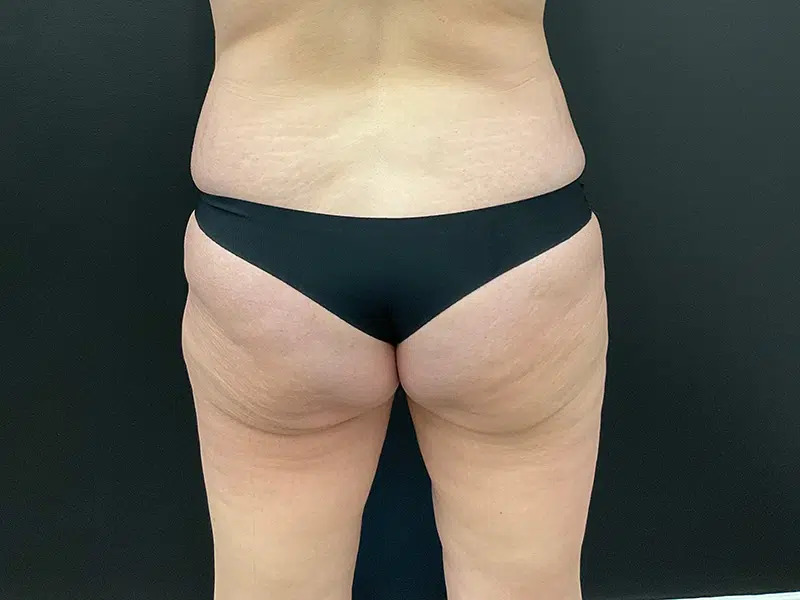 Brazilian Butt Lift Before & After Image