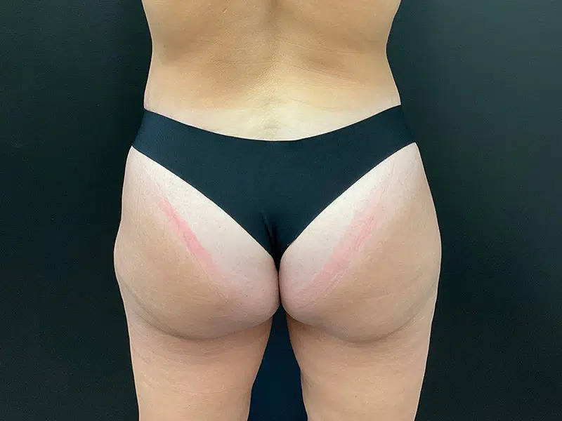 Brazilian Butt Lift Before & After Image