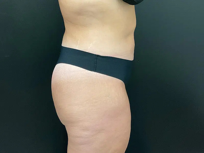 Brazilian Butt Lift Before & After Image