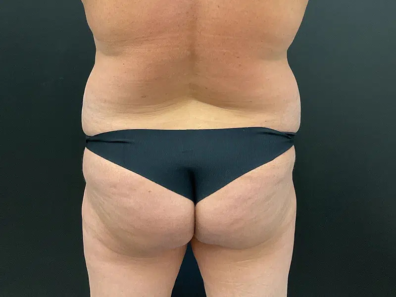 Brazilian Butt Lift Before & After Image