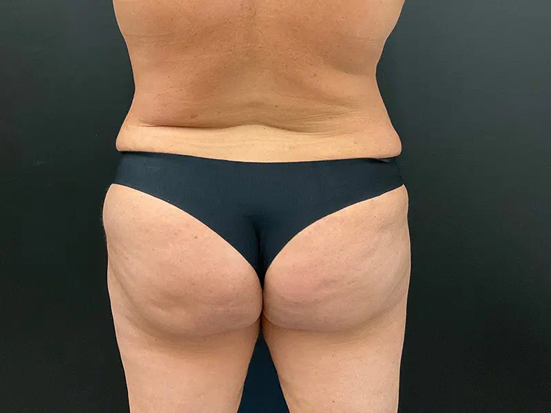 Brazilian Butt Lift Before & After Image