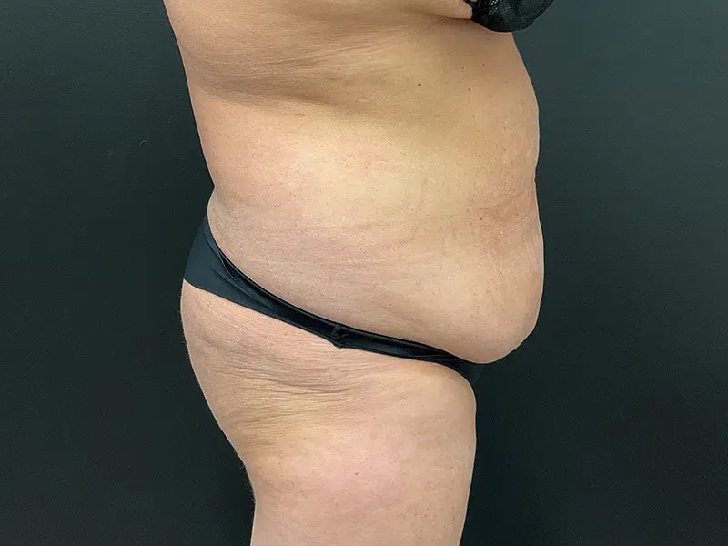 Brazilian Butt Lift Before & After Image