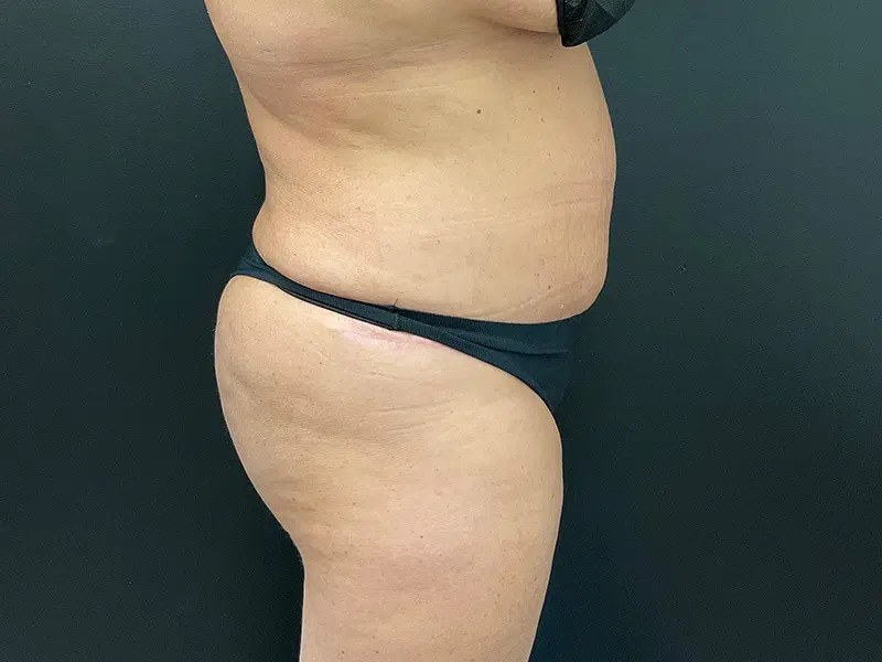 Brazilian Butt Lift Before & After Image