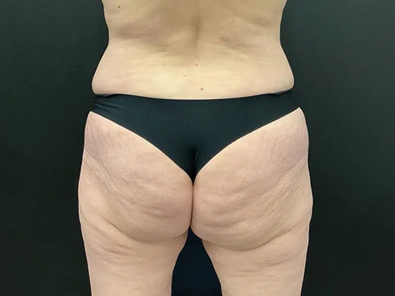 Brazilian Butt Lift Before & After Image