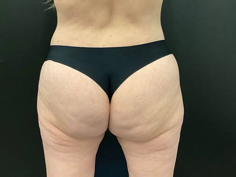 Brazilian Butt Lift Before & After Image