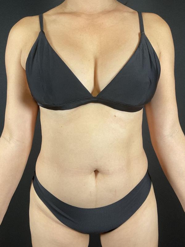 Liposuction Before & After Image