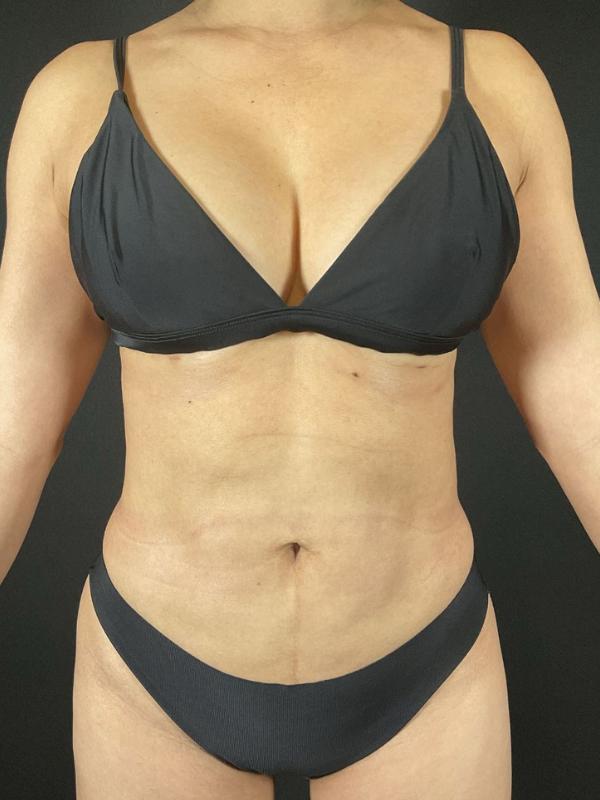 Liposuction Before & After Image