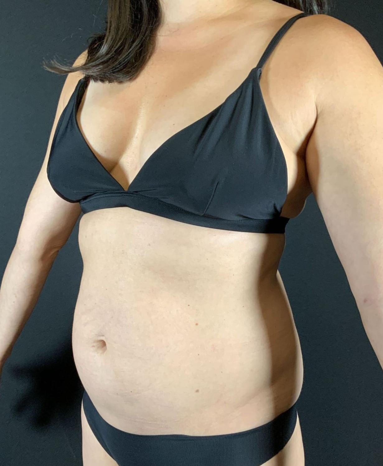 Liposuction Before & After Image