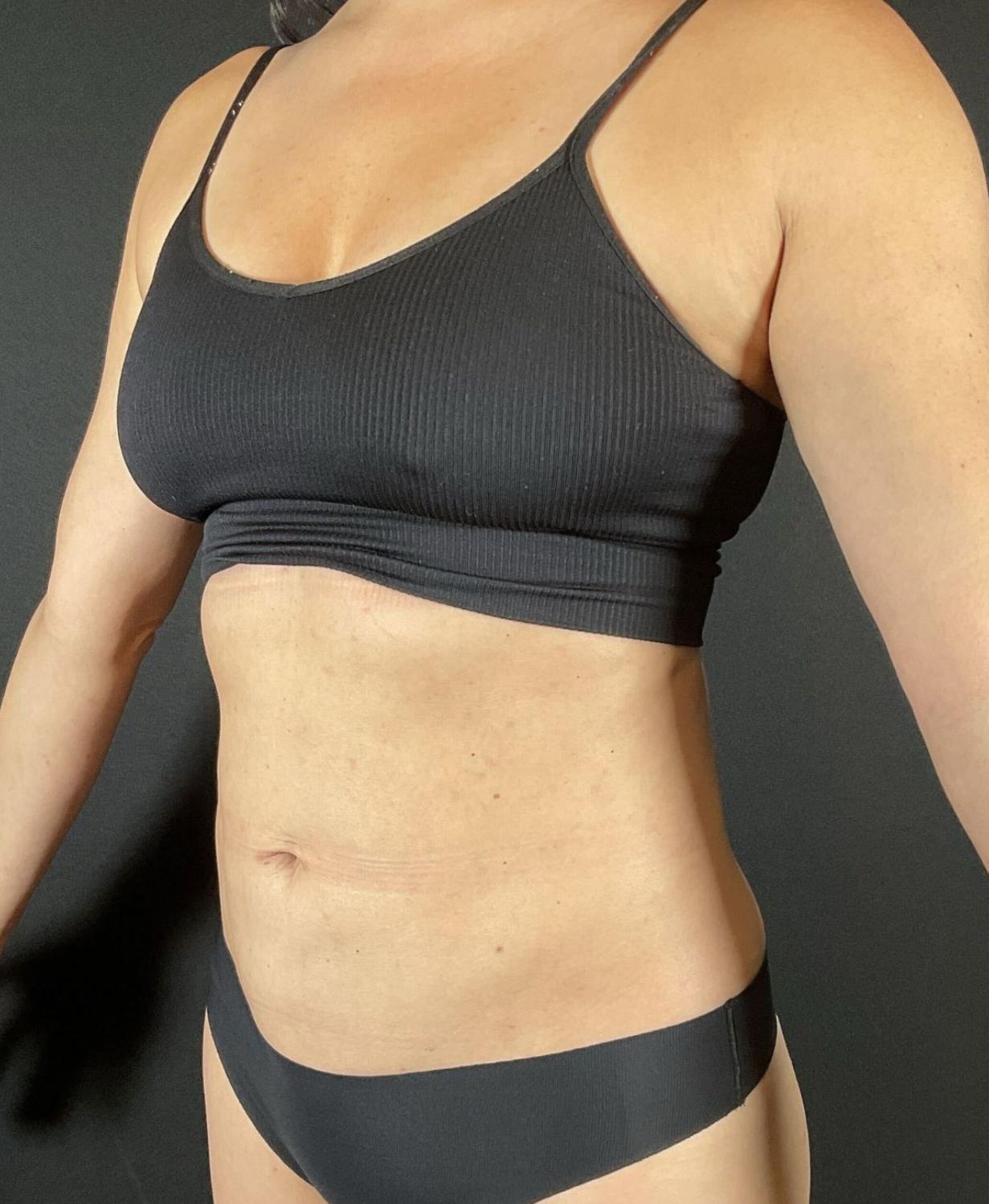 Liposuction Before & After Image