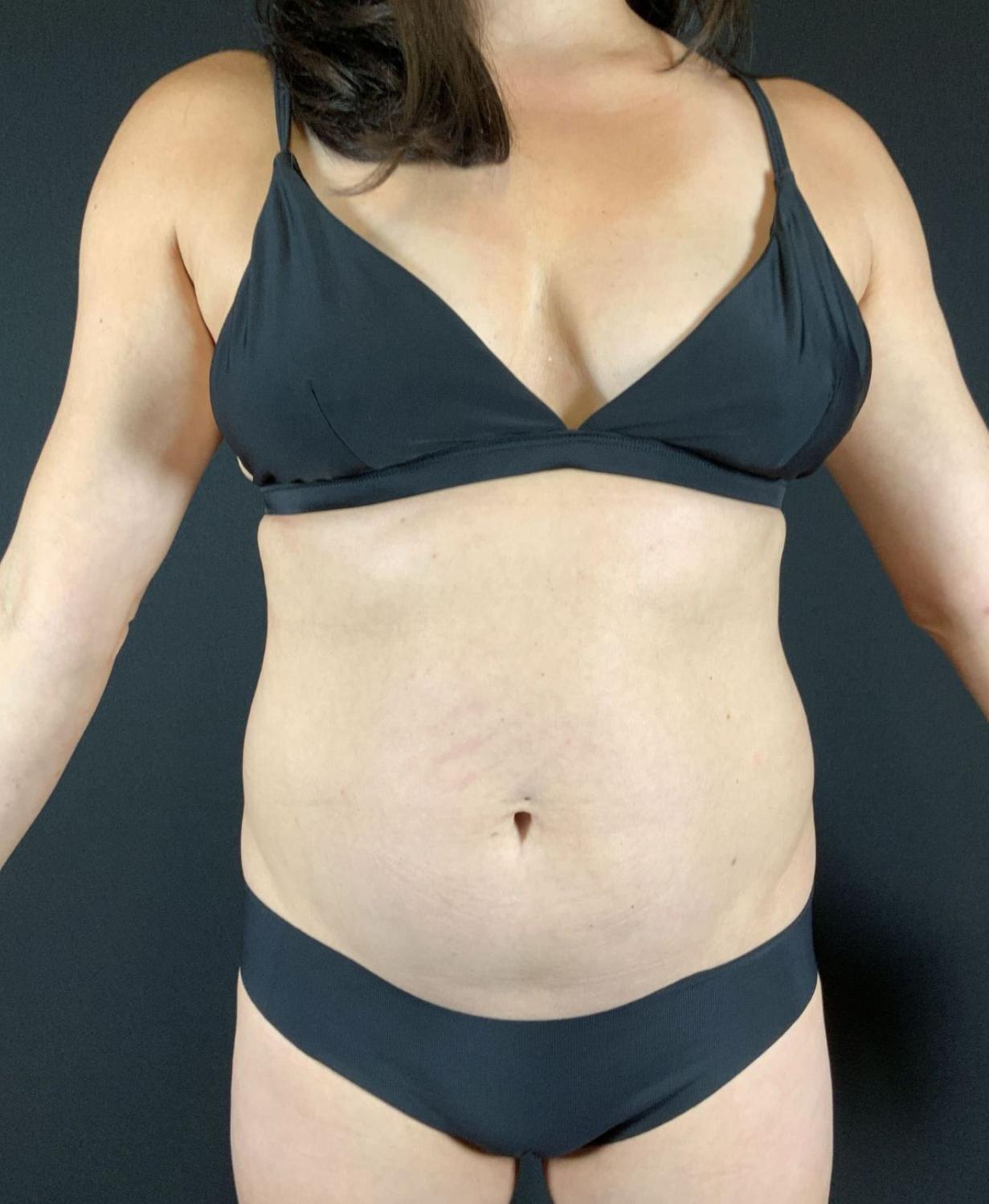 Liposuction Before & After Image