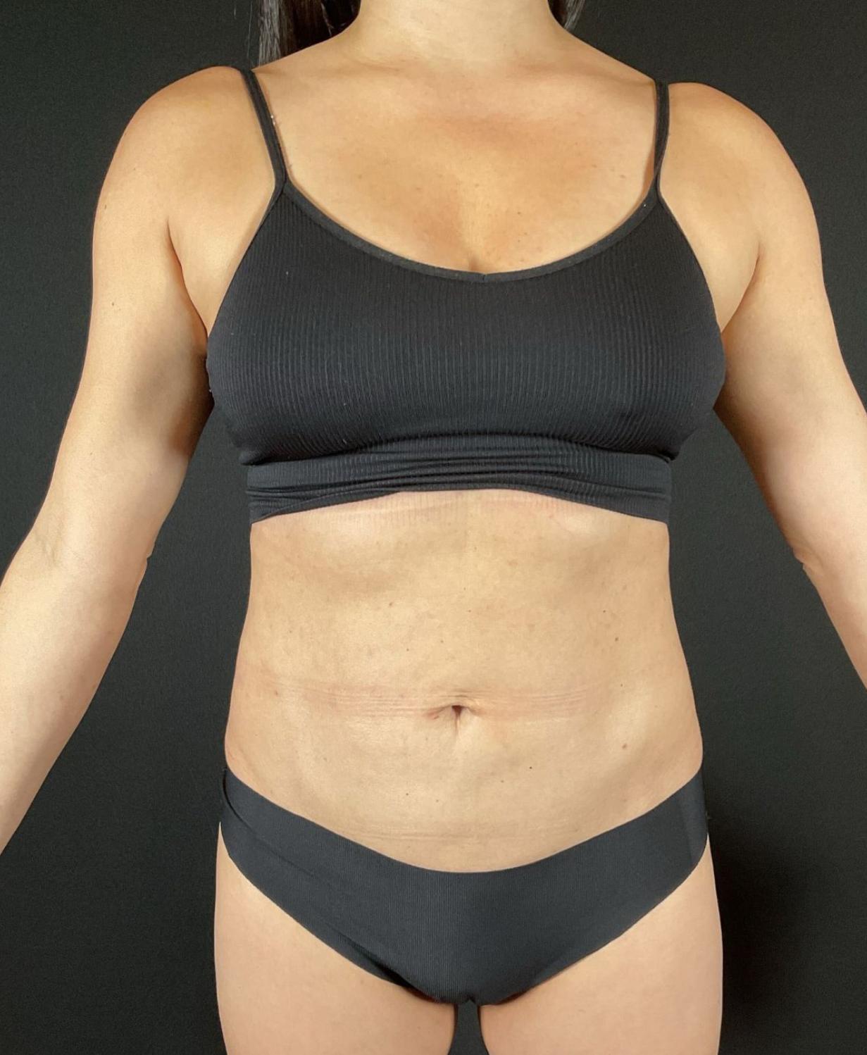 Liposuction Before & After Image