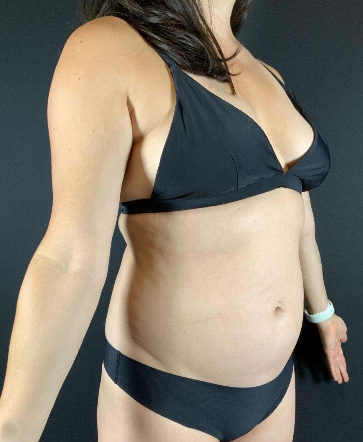 Liposuction Before & After Image