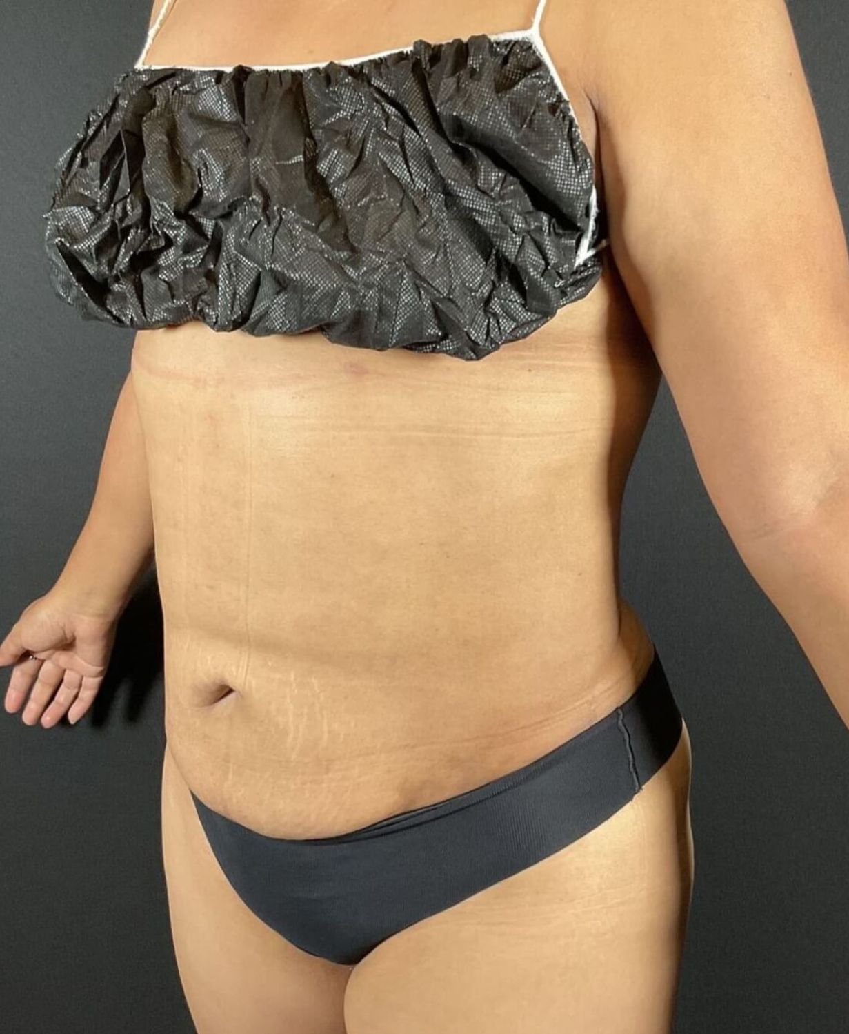 Liposuction Before & After Image