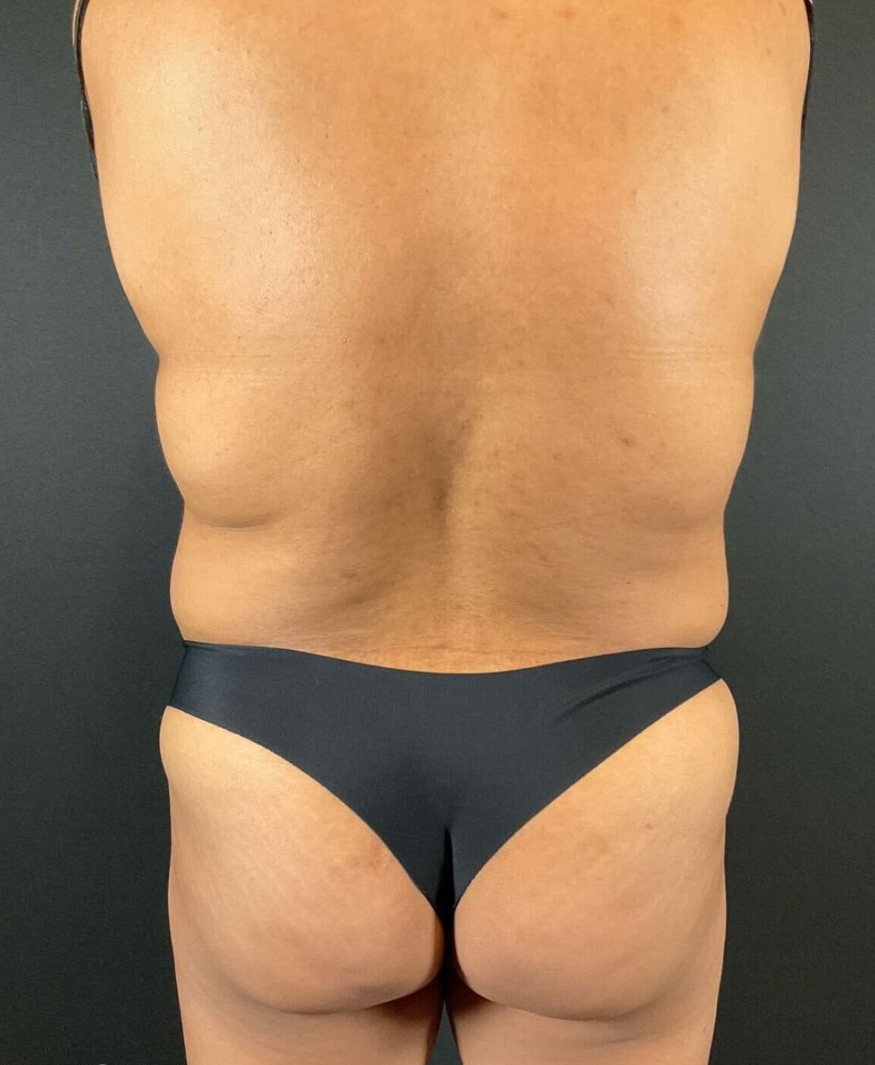 Liposuction Before & After Image