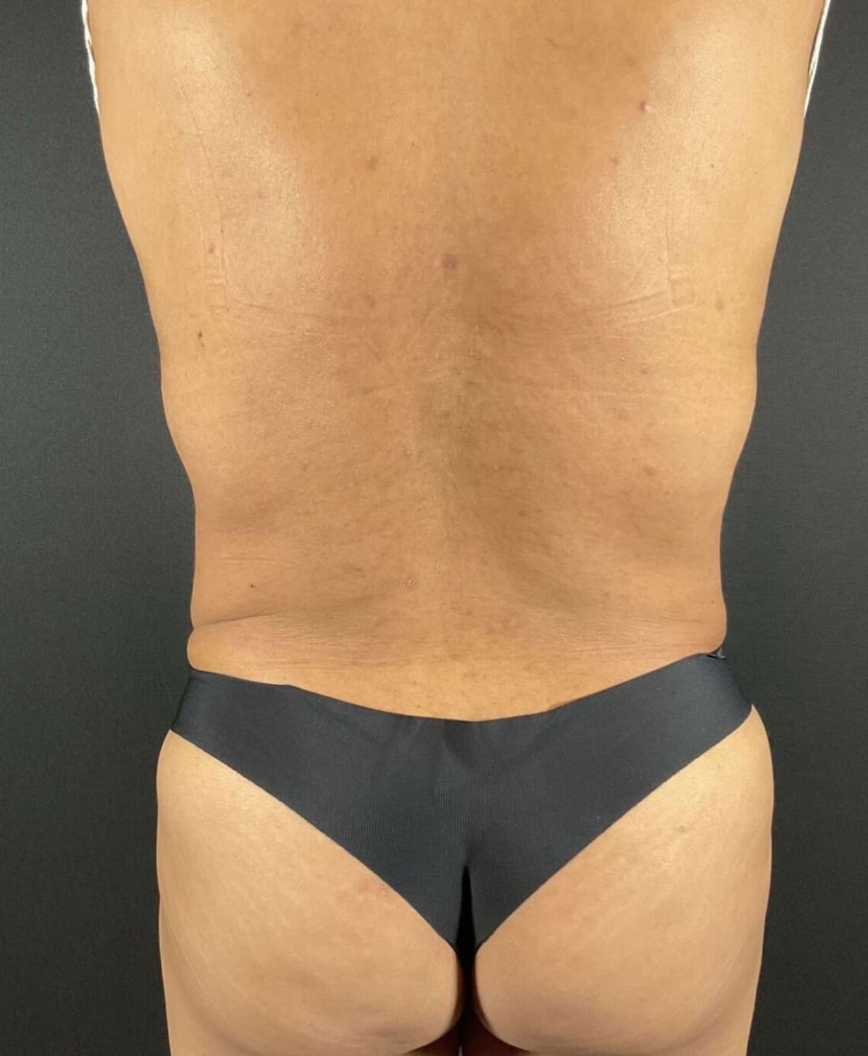 Liposuction Before & After Image