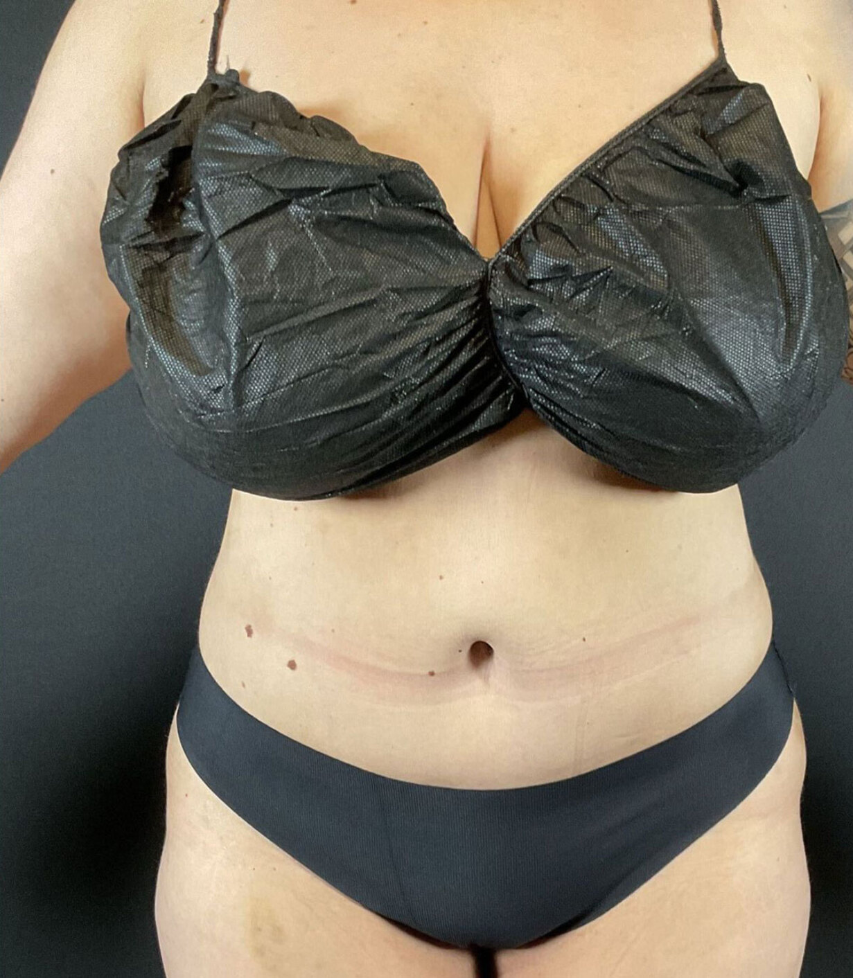 Liposuction Before & After Image