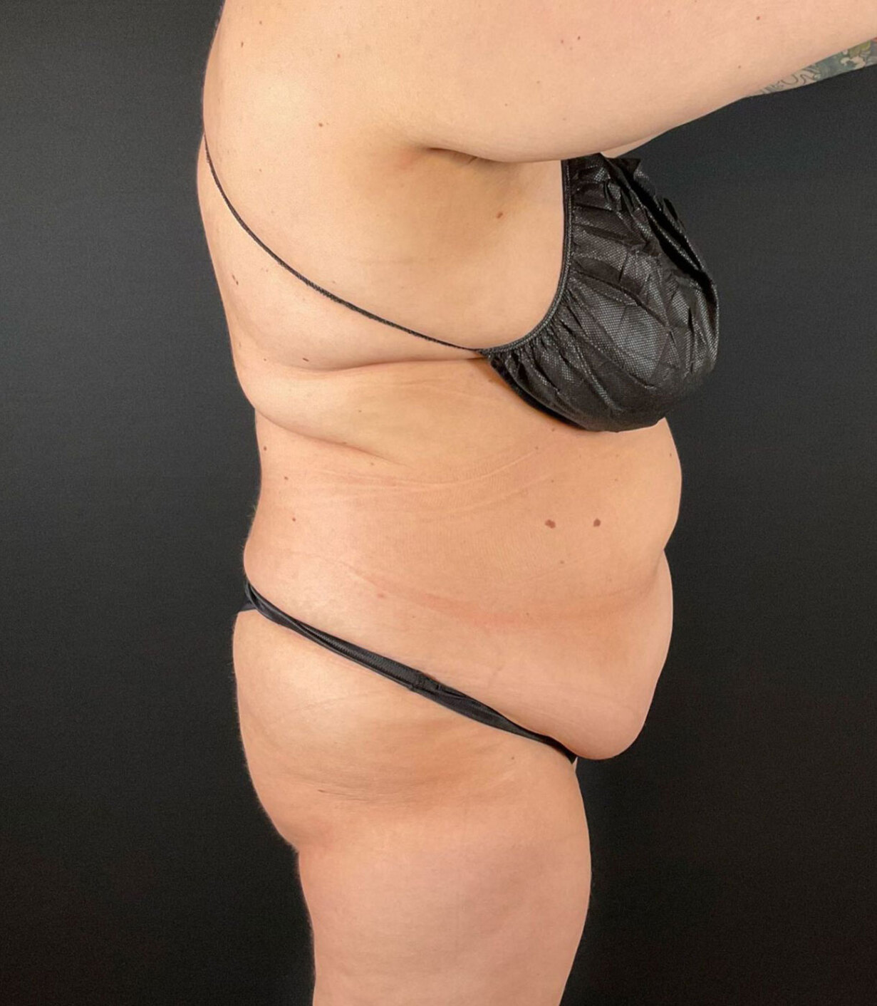 Liposuction Before & After Image