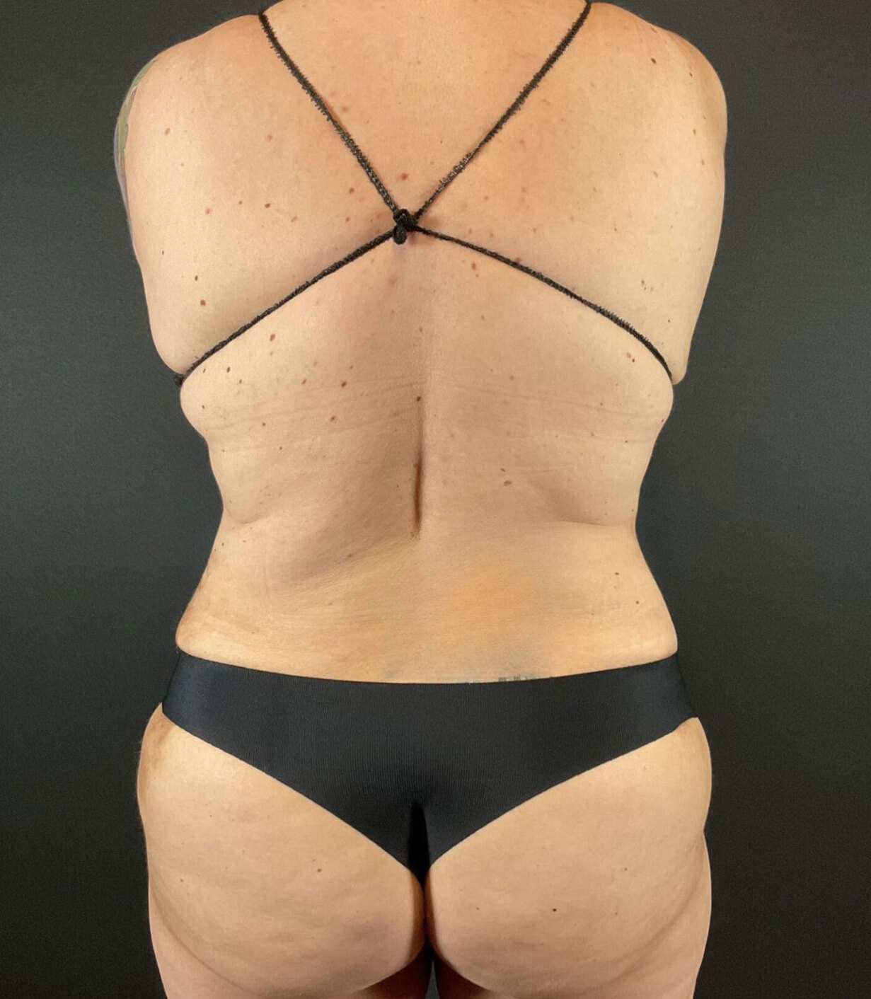 Liposuction Before & After Image