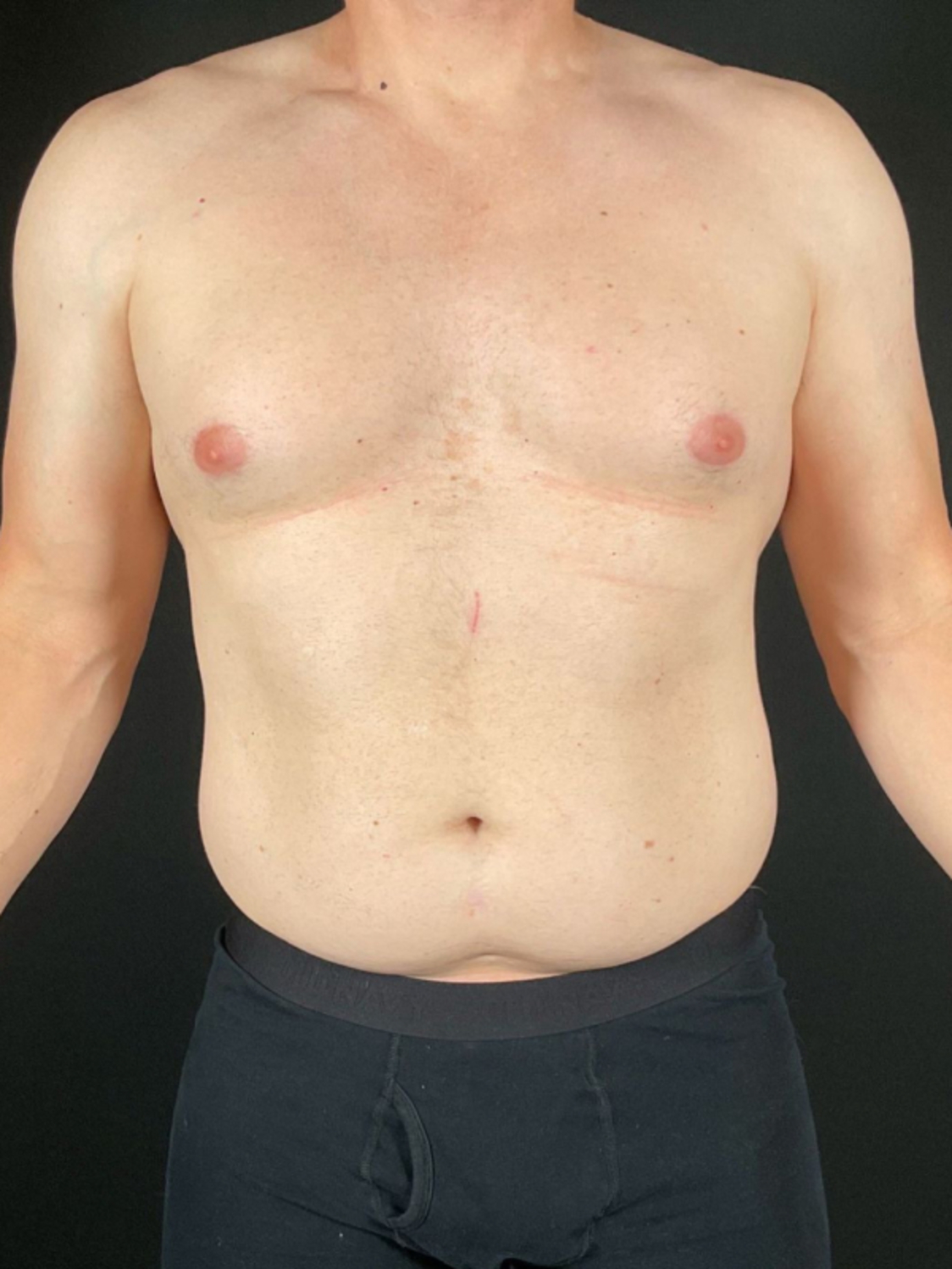 Liposuction Before & After Image