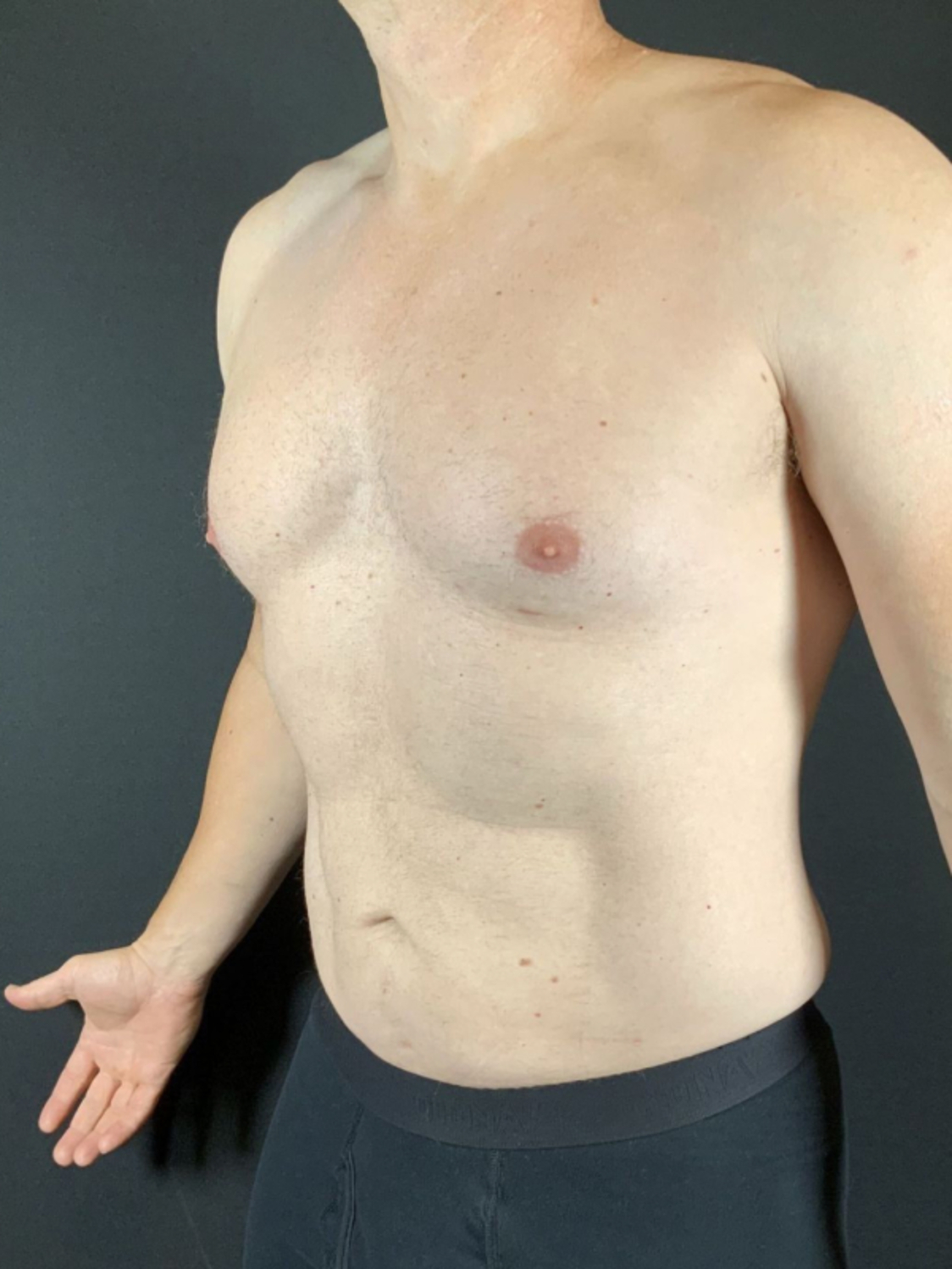 Liposuction Before & After Image