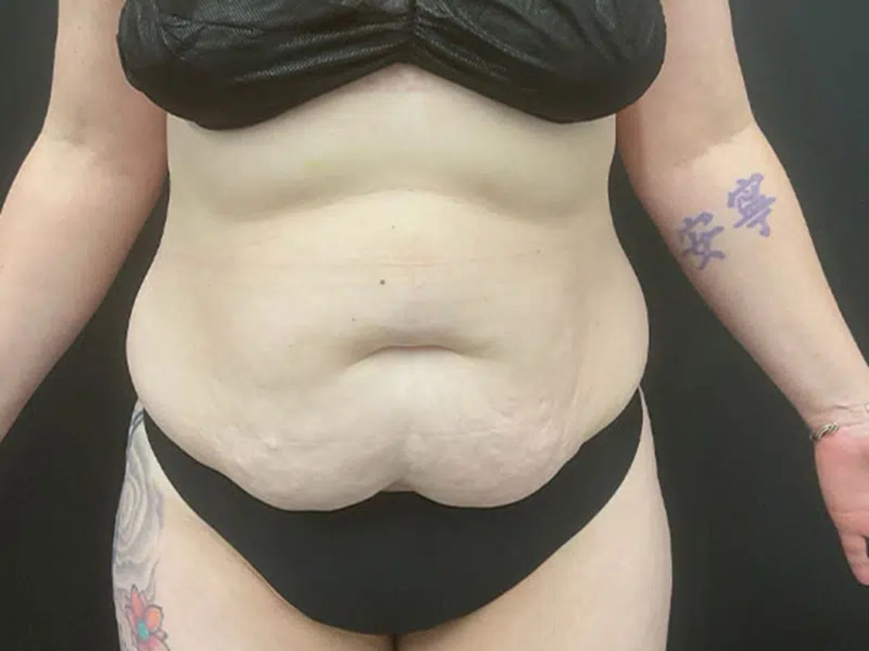 Liposuction Before & After Image