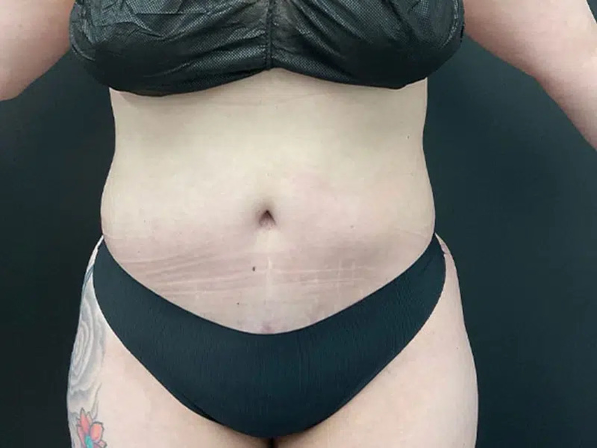 Liposuction Before & After Image