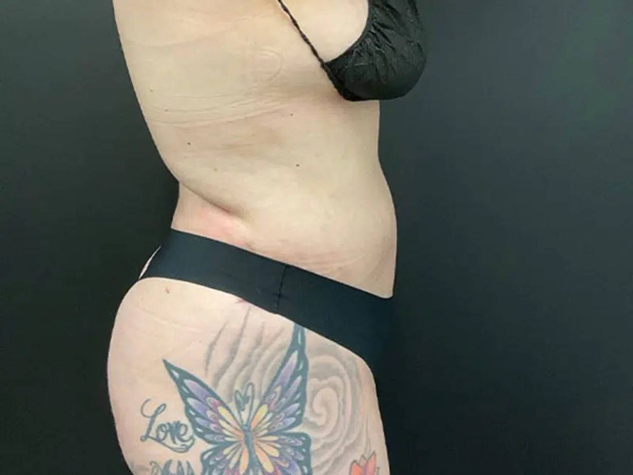 Liposuction Before & After Image