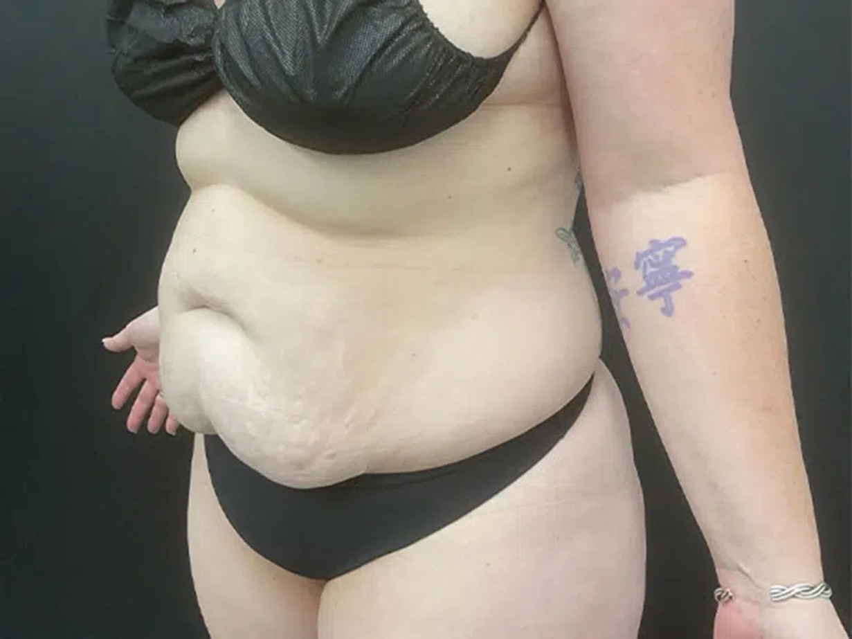 Liposuction Before & After Image