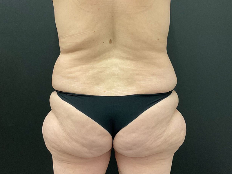 Lower Body Lift Before & After Image