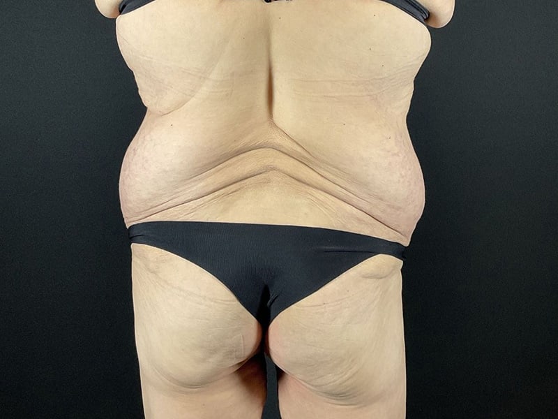 Lower Body Lift Before & After Image