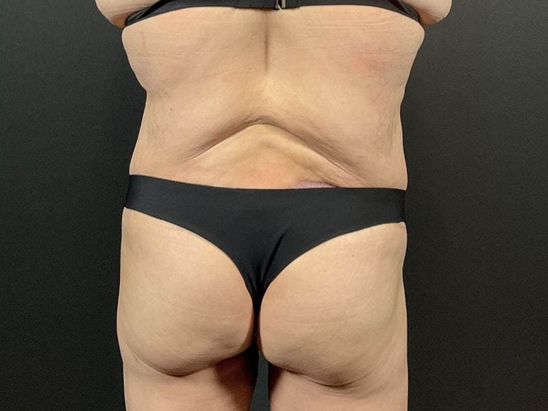 Lower Body Lift Before & After Image