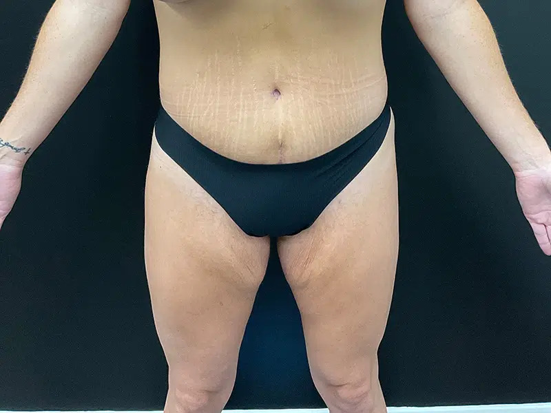 Lower Body Lift Before & After Image