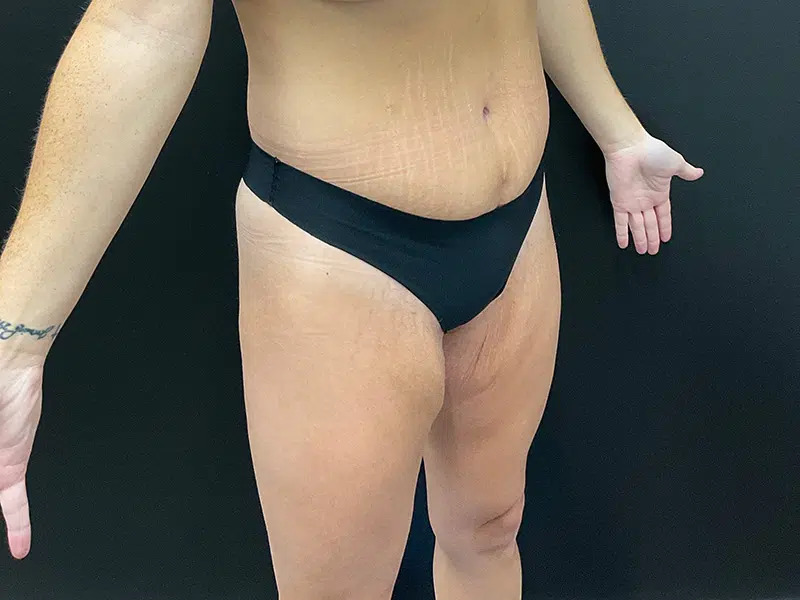 Lower Body Lift Before & After Image