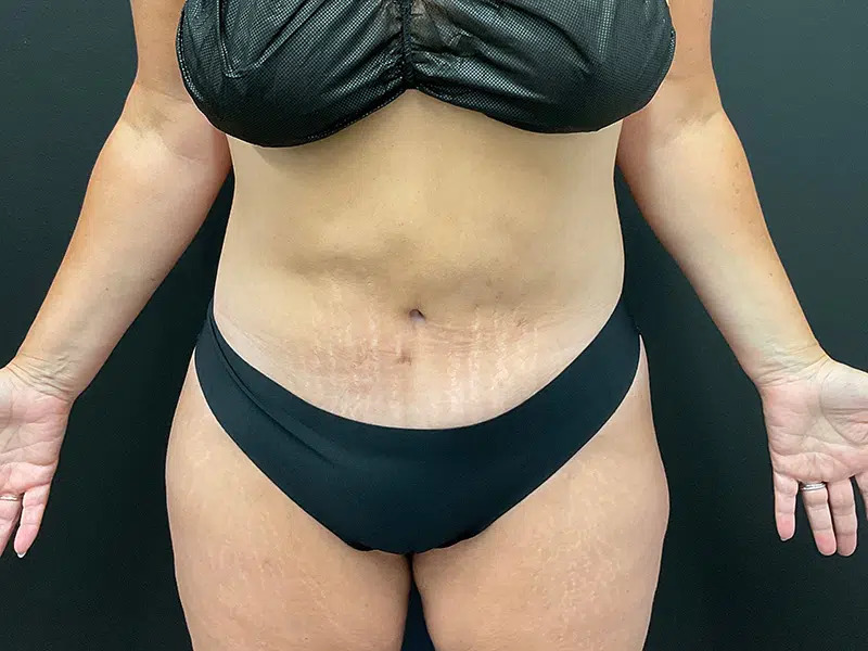 Lower Body Lift Before & After Image