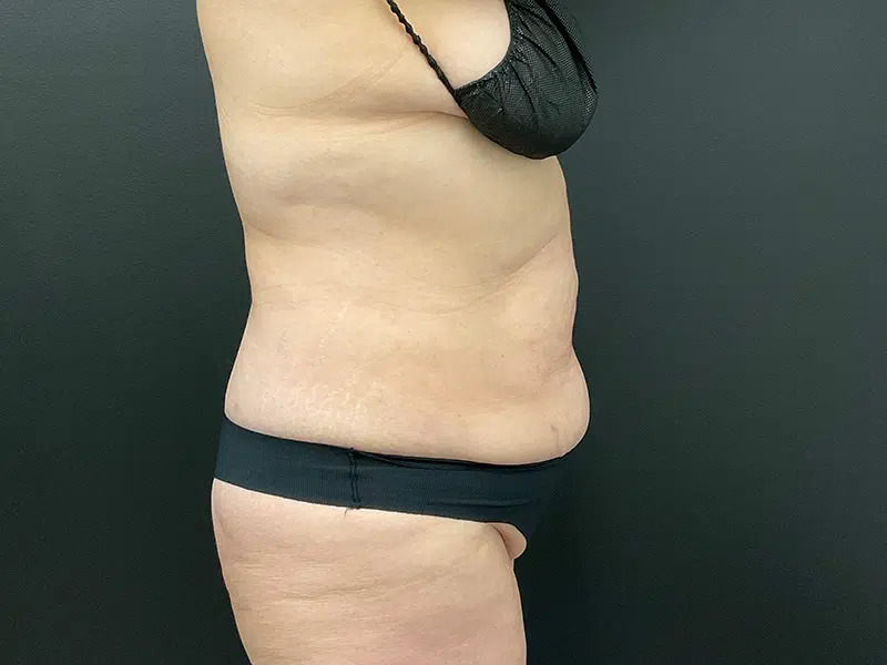 Lower Body Lift Before & After Image