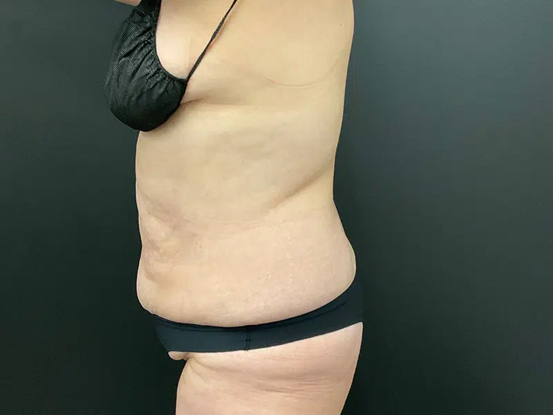 Lower Body Lift Before & After Image