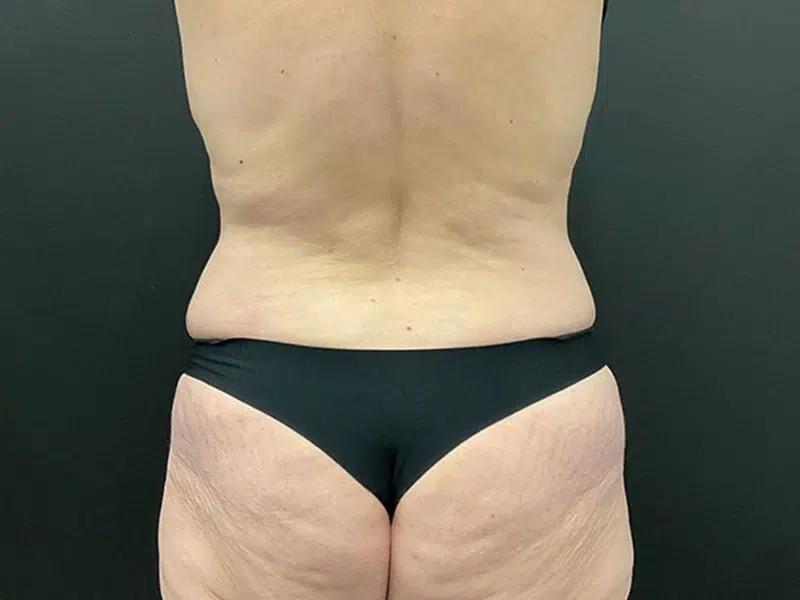 Lower Body Lift Before & After Image