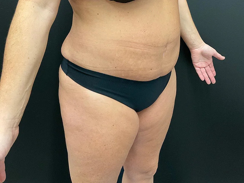 Lower Body Lift Before & After Image