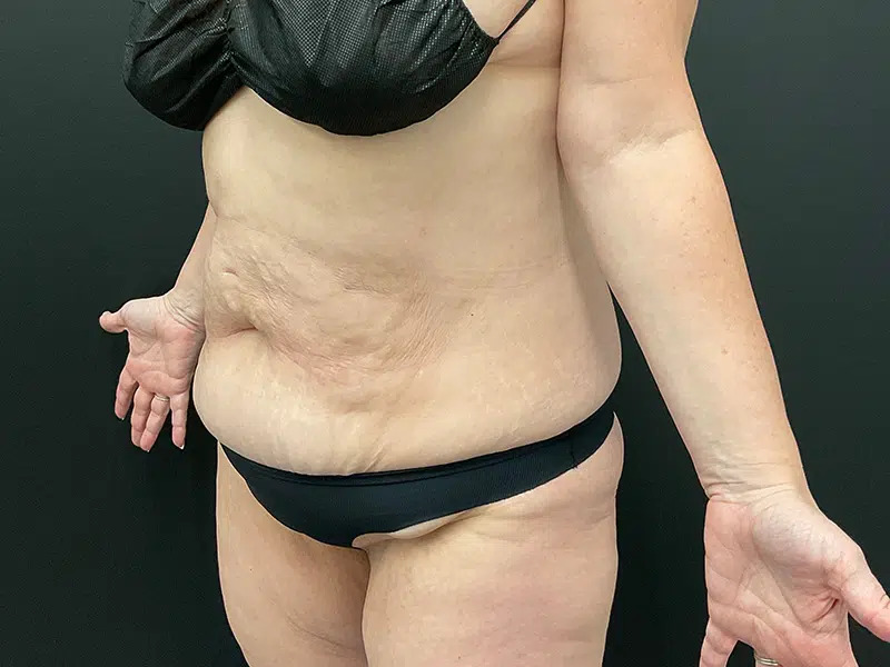 Lower Body Lift Before & After Image