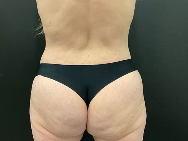 Lower Body Lift Before & After Image